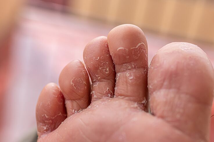 huba kože prstov - počiatočné štádium