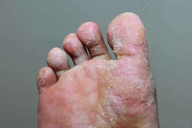 závažné štádium mykózy kože prstov na nohách