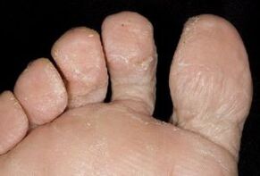 príznaky huby na koži nôh