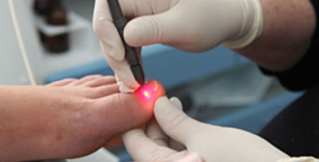 Laserová terapia plesní nechtov na nohách