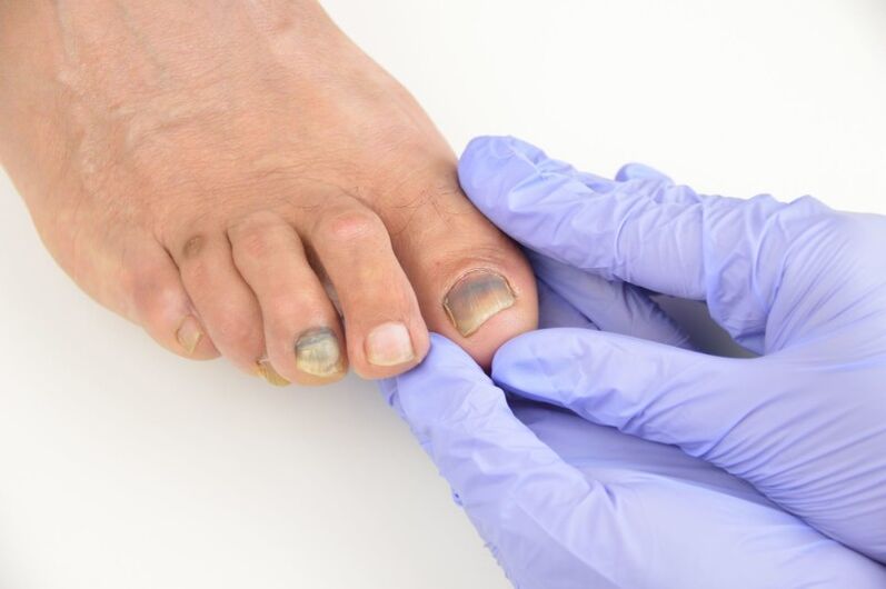 Lekárske vyšetrenie nechtov na nohách postihnutých plesňou